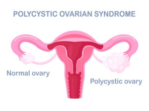 diagram of normal vs polycystic ovary to illustrate PCOS and pregnancy