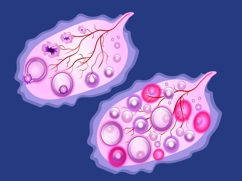 illustration of the difference between a normal ovary and one with PCOS or polycystic ovary syndrome