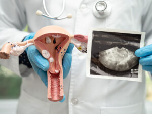 doctor holding model and photo of uterus to explain chances of getting pregnant with polycystic ovary syndrome