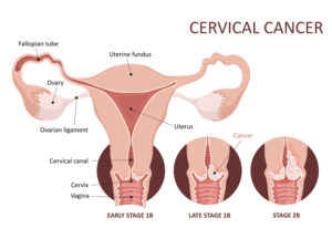 Graphic illustrating stages of cervical cancer