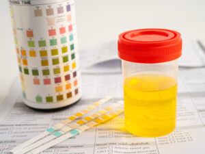urinalysis equipment to illustrate testing urine for possible diagnosis of preeclampsia
