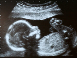 ultrasound of fetus to illustrate fetal conditions in high-risk pregnancies